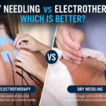 Dry Needling vs Electrotherapy: Which Is Better?