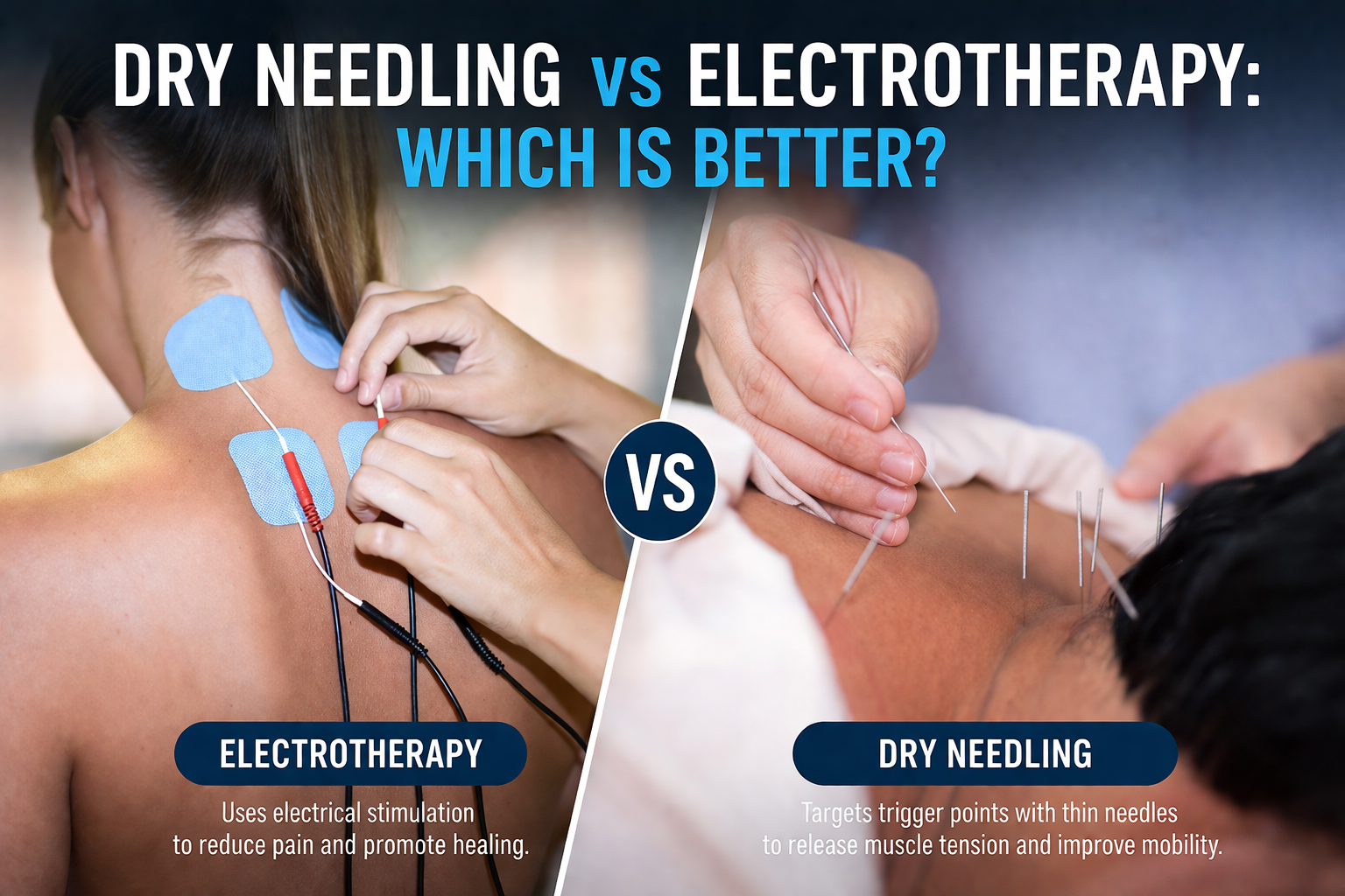 Dry Needling vs Electrotherapy: Which Is Better?